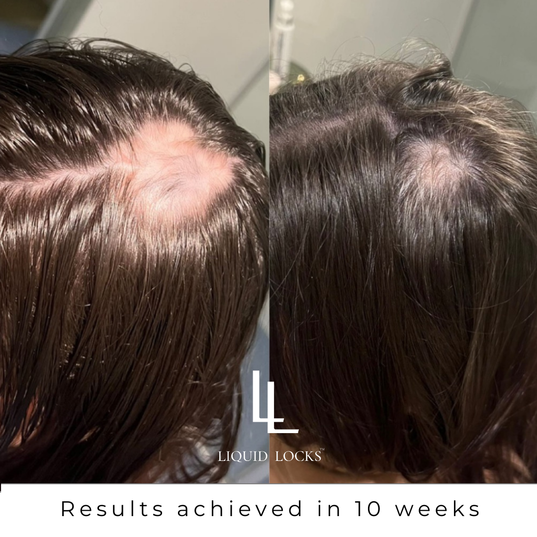 Alopecia, Sensitive Scalps and Why What You Put On Your Head Matters