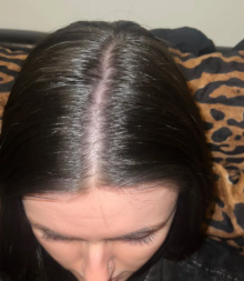 5 Months Post