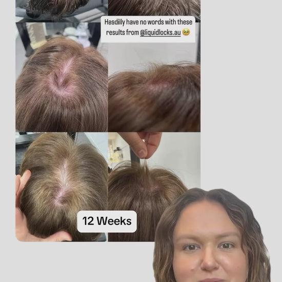 “Drs said her hair wouldn’t grow back” - Urban Hair Wonthaggi

#liquidlocks #hairgrowth #hairhealth #hairtok #australianmade